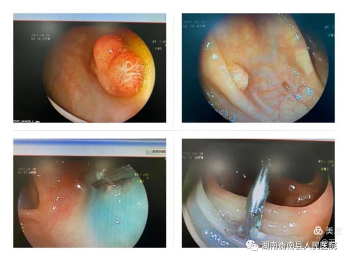衡南县人民医院成功为一例结肠多发息肉81岁高龄患者内镜下行emr术